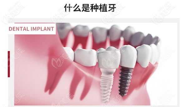 什么是種植牙 什么是種植牙