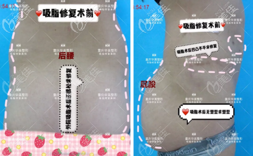 吸脂失敗照片 吸脂失敗照片
