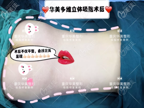 重慶華美多維立體吸脂案例 重慶華美多維立體吸脂案例