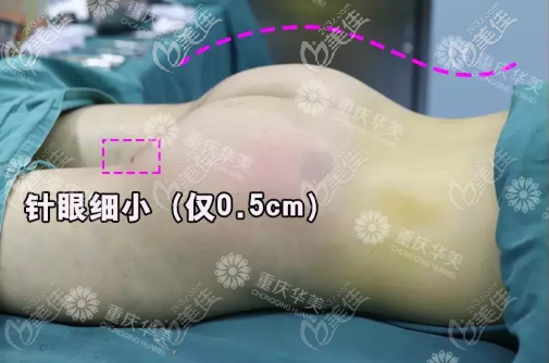 0.5厘米的針眼 0.5厘米的針眼