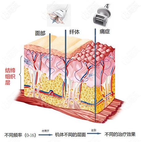 法國(guó)LPG原理 法國(guó)LPG原理
