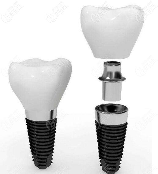 美國(guó)皓圣種植體外形示意圖 美國(guó)皓圣種植體外形示意圖