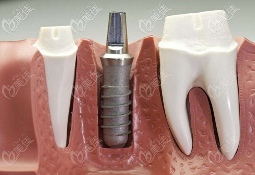種植牙過程 種植牙過程