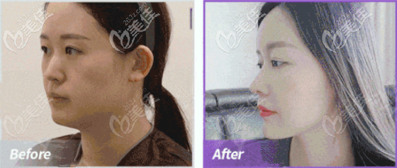 韓國RE麗顏麗能做駝峰鼻矯正嗎