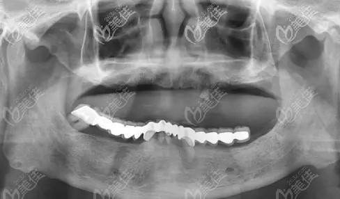 牙齒三度松動(dòng) 牙齒三度松動(dòng)