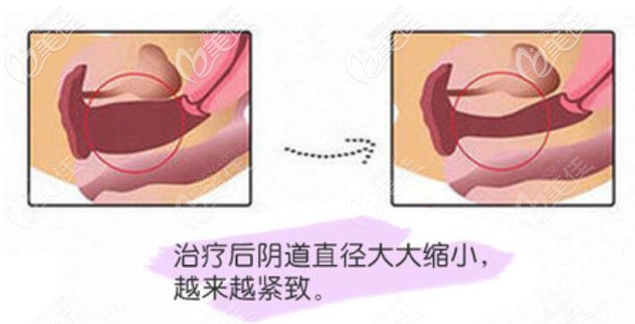 菲蜜麗緊縮術(shù)后效果對比