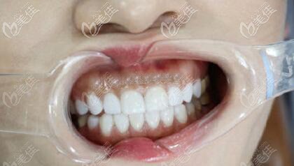 做美國(guó)皓圣種植體三個(gè)月效果圖片 做美國(guó)皓圣種植體三個(gè)月效果圖片