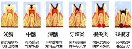 牙髓炎的發(fā)展 牙髓炎的發(fā)展