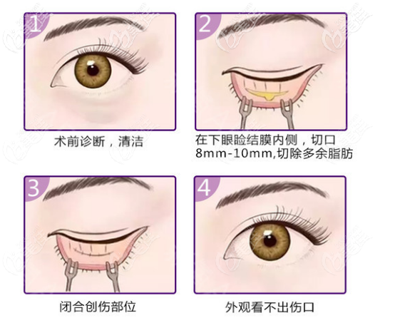 陳振雨做眼部整形的流程