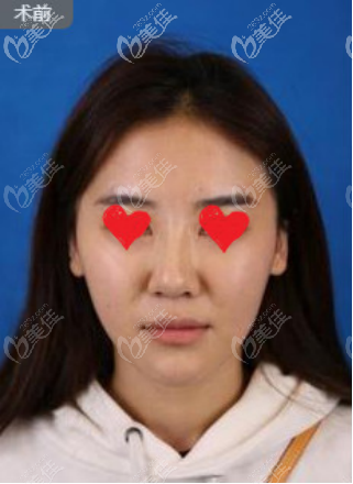 鼻部術(shù)前照 鼻部術(shù)前照