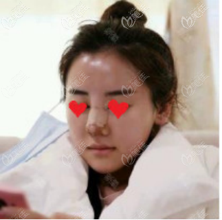 貼著膠帶的鼻子 貼著膠帶的鼻子