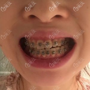 金屬托槽正畸三個(gè)月效果 金屬托槽正畸三個(gè)月效果