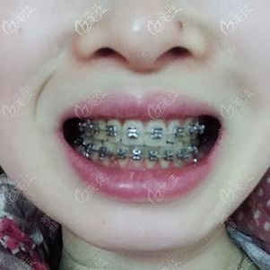 金屬托槽正畸九個(gè)月效果 金屬托槽正畸九個(gè)月效果