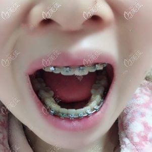 金屬托槽正畸一年效果 金屬托槽正畸一年效果