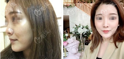 成都銅雀臺周柯半肋軟骨隆鼻實例