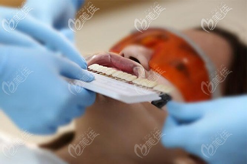 牙齒冷美白 牙齒冷美白