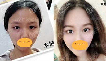 時(shí)光全切雙眼皮案例效果對(duì)比圖