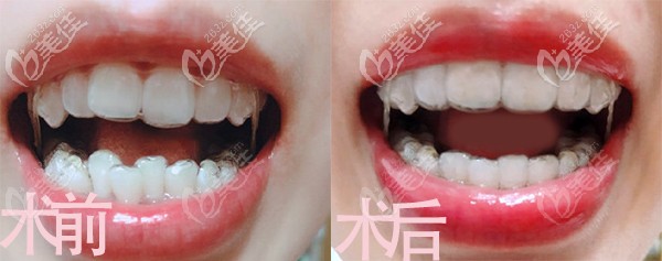 長春牙博士隱適美矯正