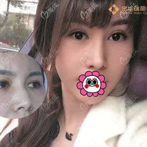 金華瑞麗蔣勁文隆鼻案例