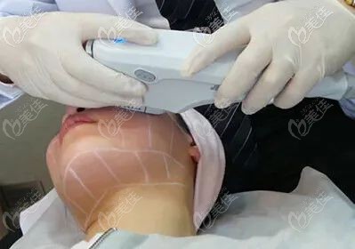 fotona4d眼周除皺治療