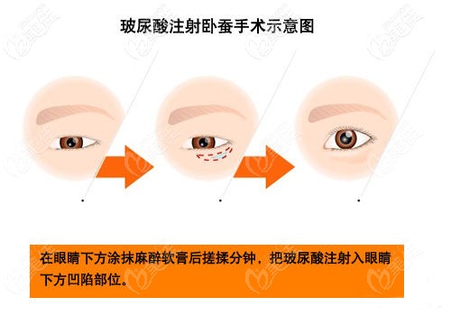 玻尿酸填充臥蠶注射點(diǎn) 玻尿酸填充臥蠶注射點(diǎn)