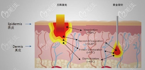 黃金微針和點(diǎn)陣激光的治療區(qū)別 黃金微針和點(diǎn)陣激光的治療區(qū)別