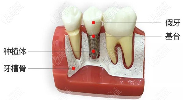 骨質(zhì)疏松癥并不是種植牙的相對(duì)禁忌癥 骨質(zhì)疏松癥并不是種植牙的相對(duì)禁忌癥