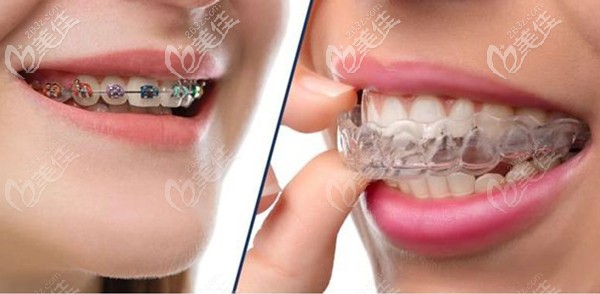 長(zhǎng)沙做牙齒矯正的收費(fèi)標(biāo)準(zhǔn) 長(zhǎng)沙做牙齒矯正的收費(fèi)標(biāo)準(zhǔn)