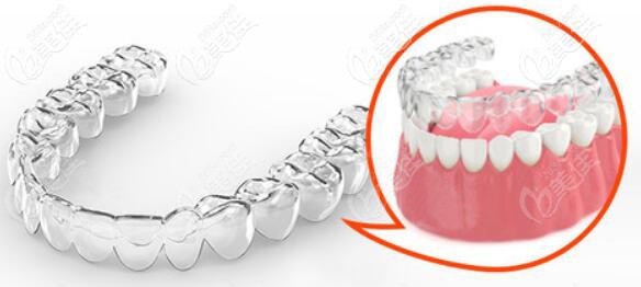 隱形牙齒矯正示意圖 隱形牙齒矯正示意圖
