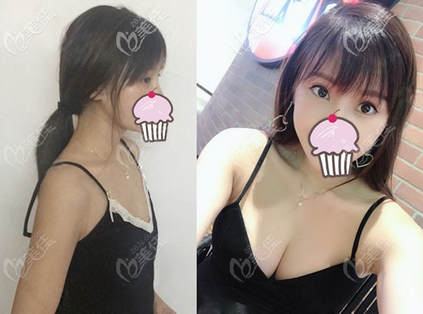 成都恒博天姿自體脂肪豐胸案例效果