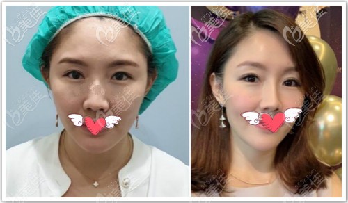 少女線提升前后對(duì)比效果照片