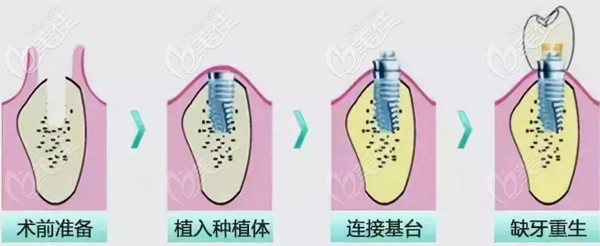 關(guān)于韓國(guó)種植牙質(zhì)量的介紹 關(guān)于韓國(guó)種植牙質(zhì)量的介紹
