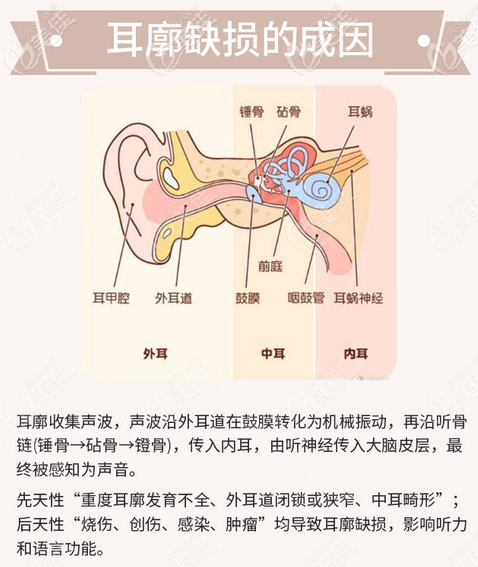 全耳再造手術(shù)之耳朵內(nèi)部結(jié)構(gòu)圖 全耳再造手術(shù)之耳朵內(nèi)部結(jié)構(gòu)圖