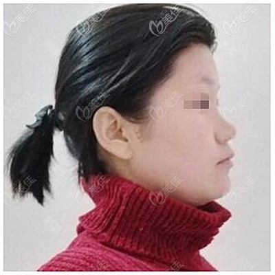 假體隆鼻手術(shù)前