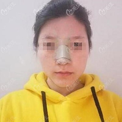 鼻綜合術(shù)后第三天