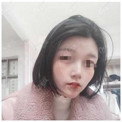 鼻綜合術(shù)后3個(gè)月