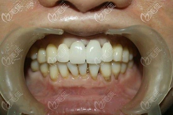 門牙缺失四顆種植案例圖片