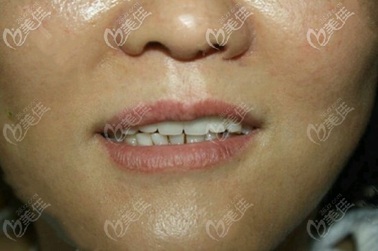 上門牙缺失4顆種植案例:她找合肥華美口腔做了韓國進口奧齒泰種植牙