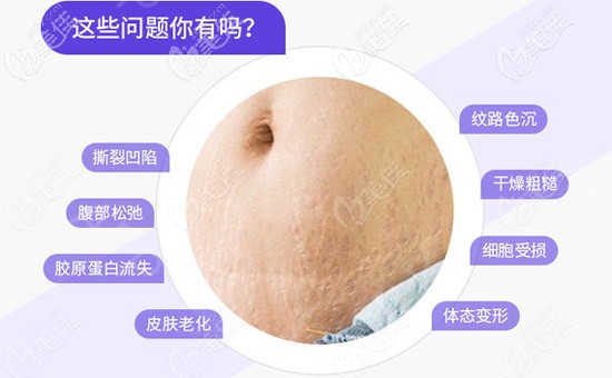 產(chǎn)后如何去掉妊娠紋？