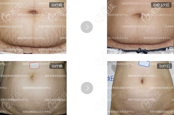 成都恒博醫(yī)院祛除妊娠紋的案例效果對比圖