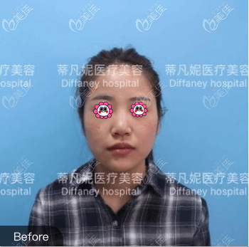 在北京蒂凡妮做肋軟骨鼻綜合前 在北京蒂凡妮做肋軟骨鼻綜合前