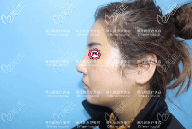 我做肋軟骨鼻綜合手術(shù)有18天了 我做肋軟骨鼻綜合手術(shù)有18天了