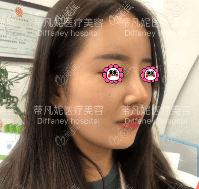 術(shù)后一個(gè)月多一日樣子 術(shù)后一個(gè)月多一日樣子