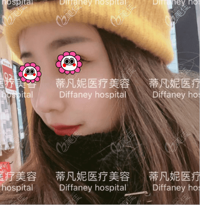 靳玉彪給我做的肋軟骨鼻綜合效果 靳玉彪給我做的肋軟骨鼻綜合效果