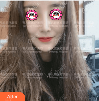 我比較喜歡靳玉彪醫(yī)生隆鼻的自然風(fēng)格,就找他做了肋軟骨鼻綜合手術(shù)