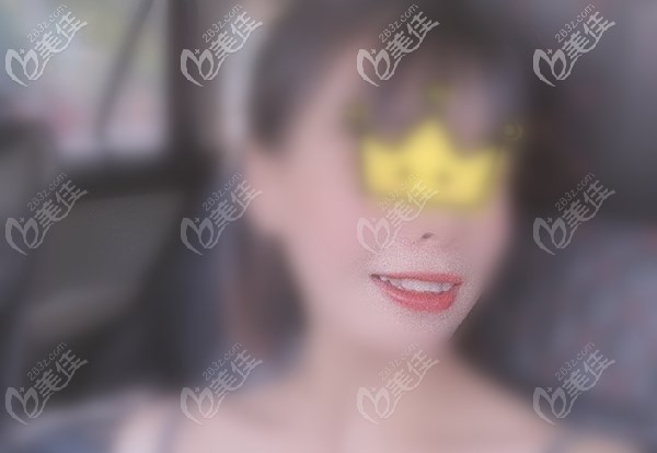 門牙種植恢復后照片 門牙種植恢復后照片