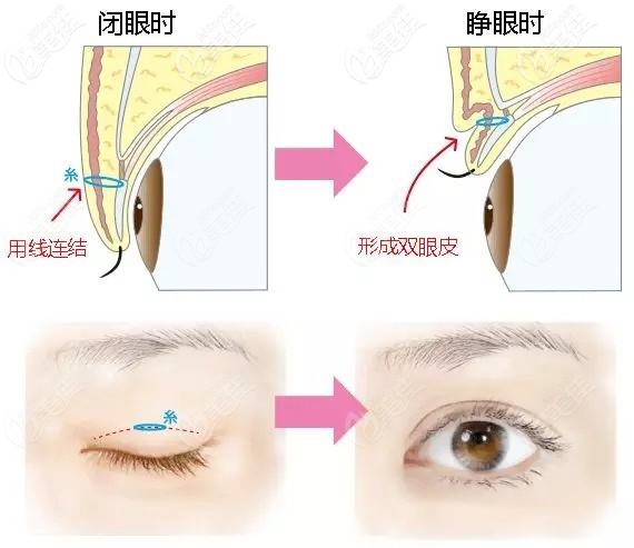 單眼皮變雙眼皮是用線連結(jié)出褶皺