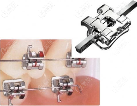 自鎖矯正優(yōu)勢(shì)