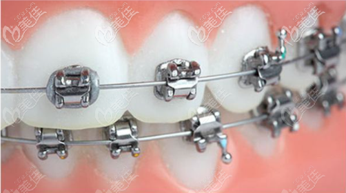 傳統(tǒng)金屬矯正