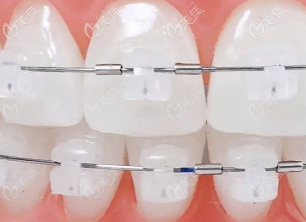 半隱形陶瓷矯正
